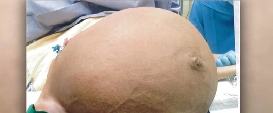 Singapur’da bir kadından 28 kilogram tümör çıkarıldı